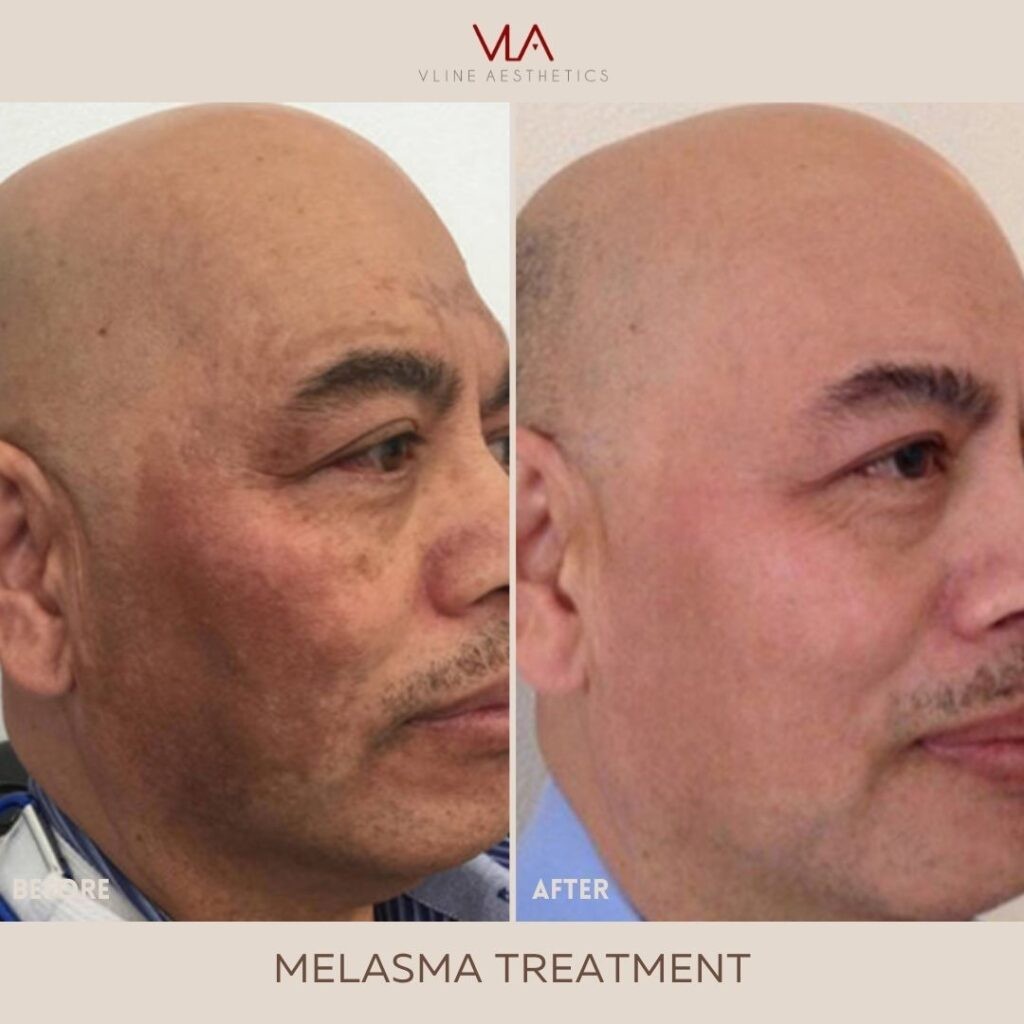 LasmaX-Skin® Anti Aging DARK SPOT CORRECTOR for Face, Body Age Spot Remover