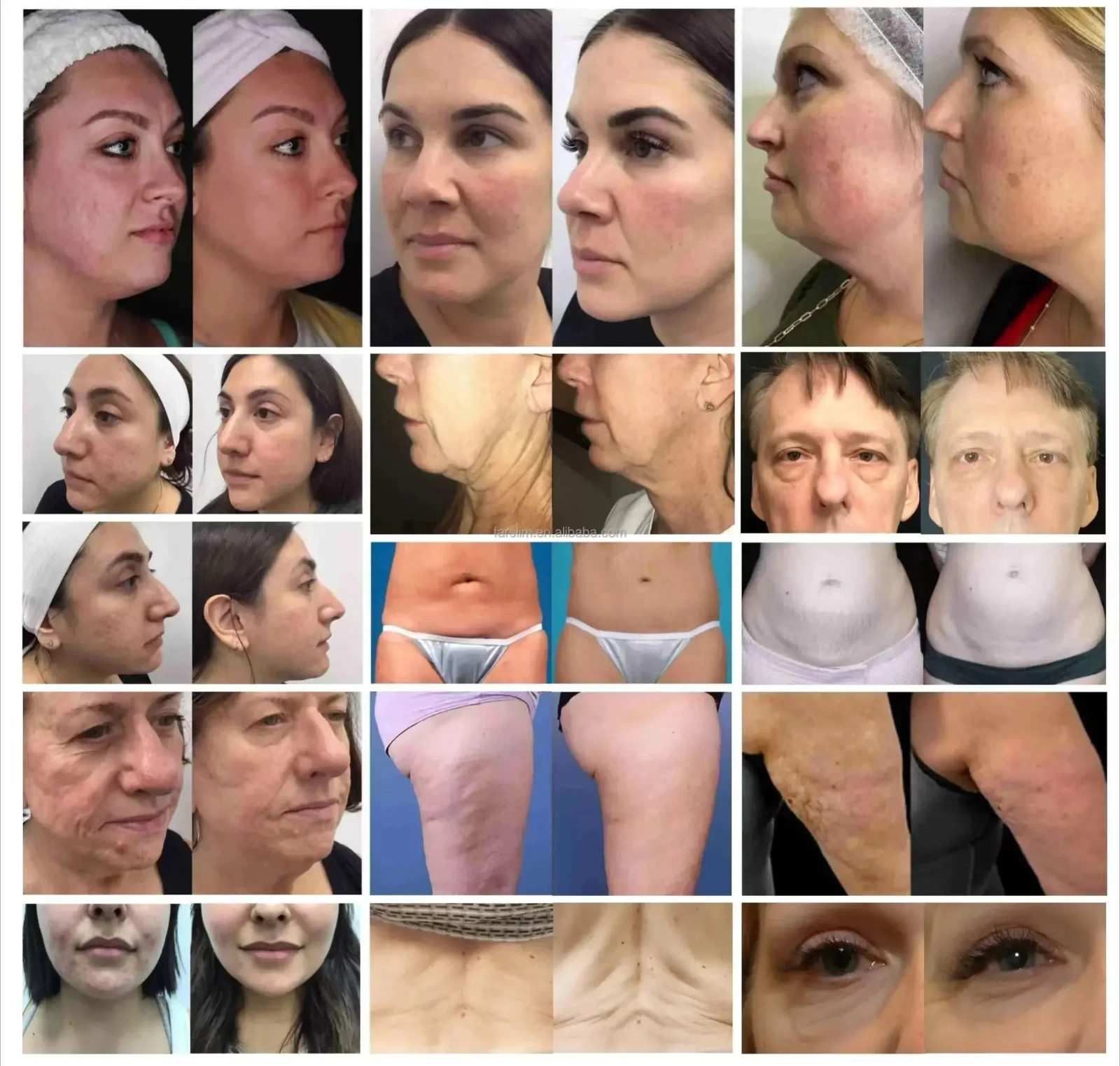 3 in 1 Professional Face Lift Body Slim Skin Firm Skin Rejuvenation Machine