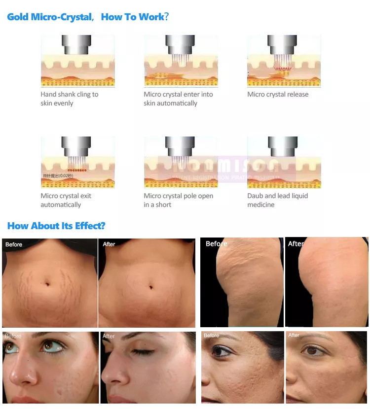 2in1 RF Micro-n-eedle Machine Cold Hammer Anti Scars Spot Wrinkle Removal Beauty