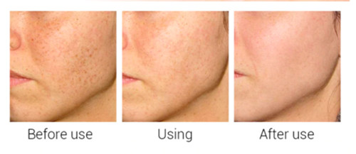 Matrixyl 3000 Peptide Hyaluronic Acid Retinol Collagen Vitamin C Cream – 1oz