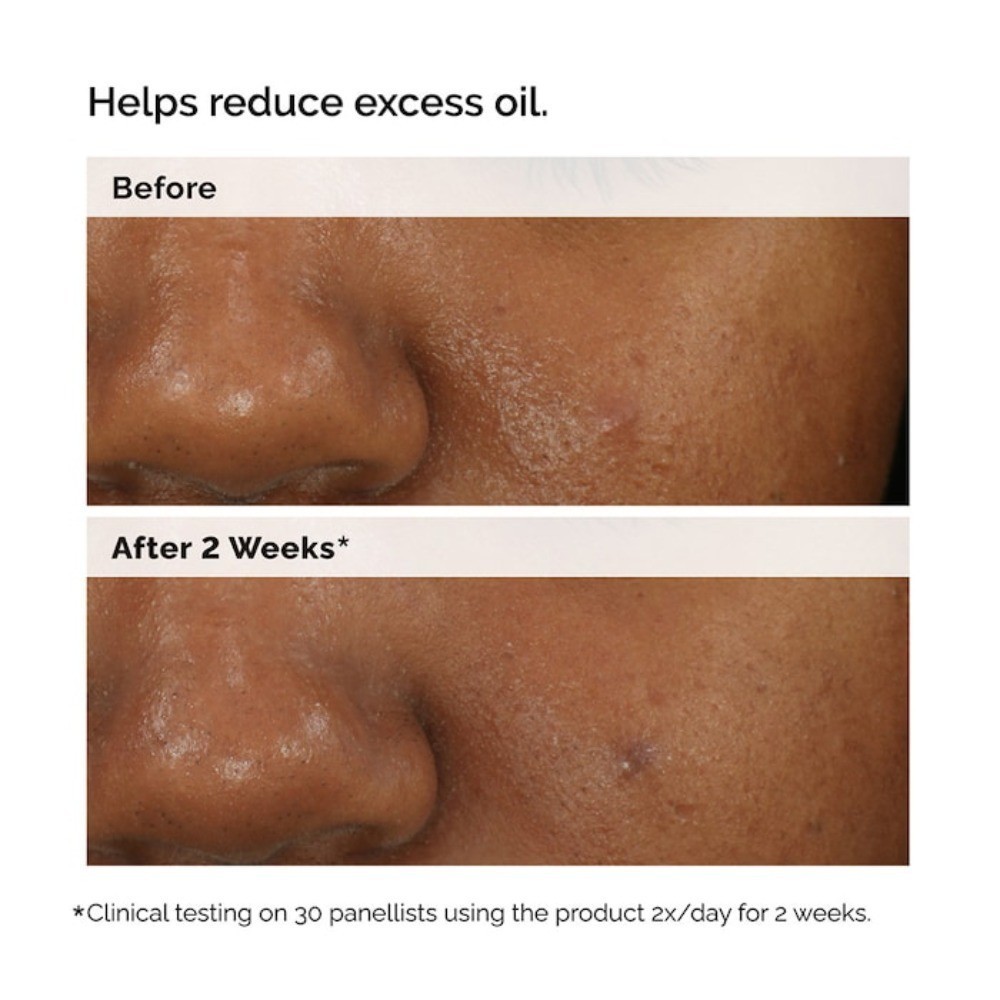 The Ordinary Authentic Clarifying Serum for Oily Skin and Pore Refinement 1 oz