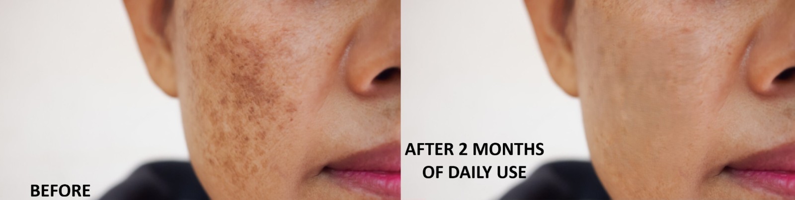 APLB Tranexamic Acid Niacinamide Serum 40ml Brightening Melasma, Dark Sun Spots