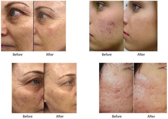 2023 New RF Body Skin Tightening Face Lift Machine
