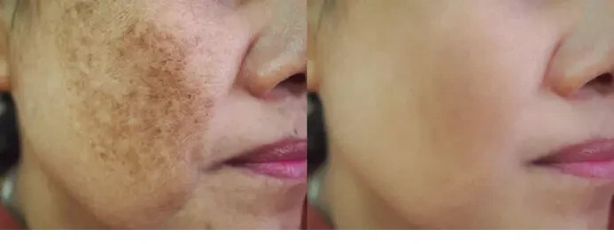 Ayurvedic Melasma Treatment Cream 30gm skin pigmentation like melasma, chloasma