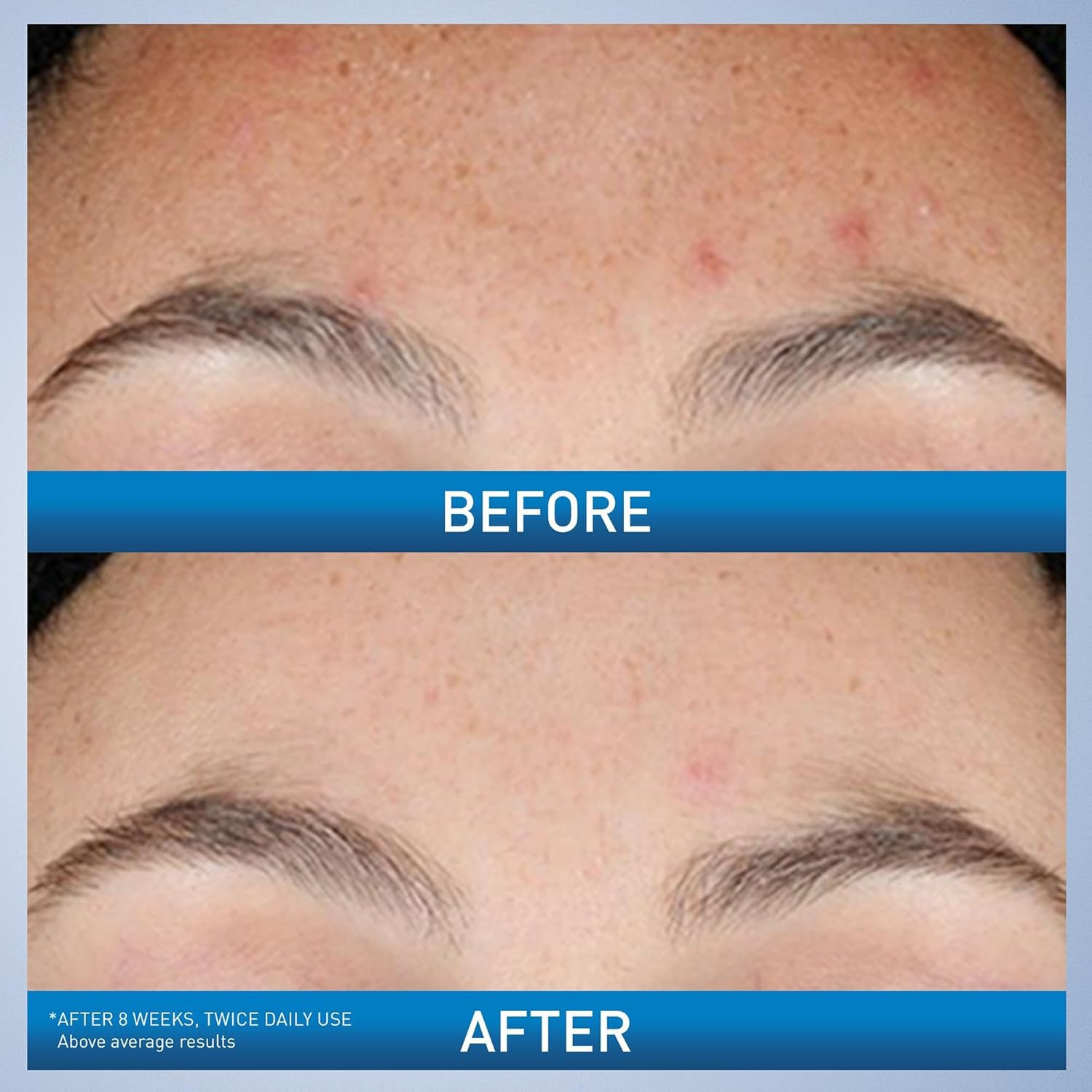 Resurfacing Retinol Serum for Post Acne Marks, Formulated with Licorice Root Ext
