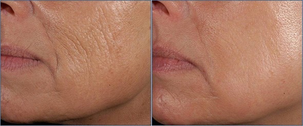 Hyaluronic Acid HA Glycolic Acid CoQ10 Strongest Anti Aging Wrinkle Cream Serum