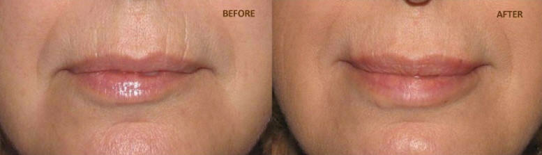 UPPER LIP PLUMPER COMPLEX ~LIP PERIORAL FILLER TREATMENT~CHAPPED LIPS NO MORE!