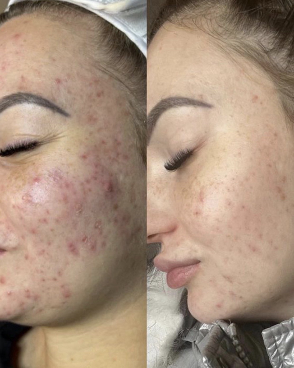 Cell Story Liquid Microneedling
